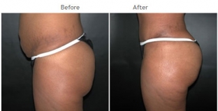 Brazilian Butt Lift New York City Patient 1035 - Butt augmentation NYC