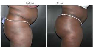 Brazilian Butt Lift New York City Patient 1032 - Butt implants NYC